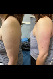 نمونه قبل و بعد استفاده از دستگاه اکسلیس برای لاغری بازو